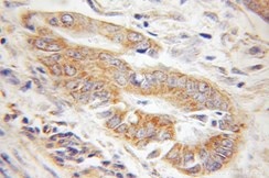 TOM22抗体を使用したパラフィン包埋ヒト結腸癌の免疫組織化学染色