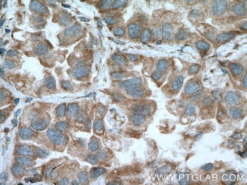 MFN1抗体を使用したパラフィン包埋ヒト肺癌組織スライドの免疫組織化学染色