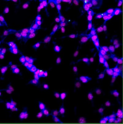 蛍光ナノダイヤモンドを取り込んだ大腸癌細胞の多重染色画像（蛍光ナノダイヤモンドを検出）