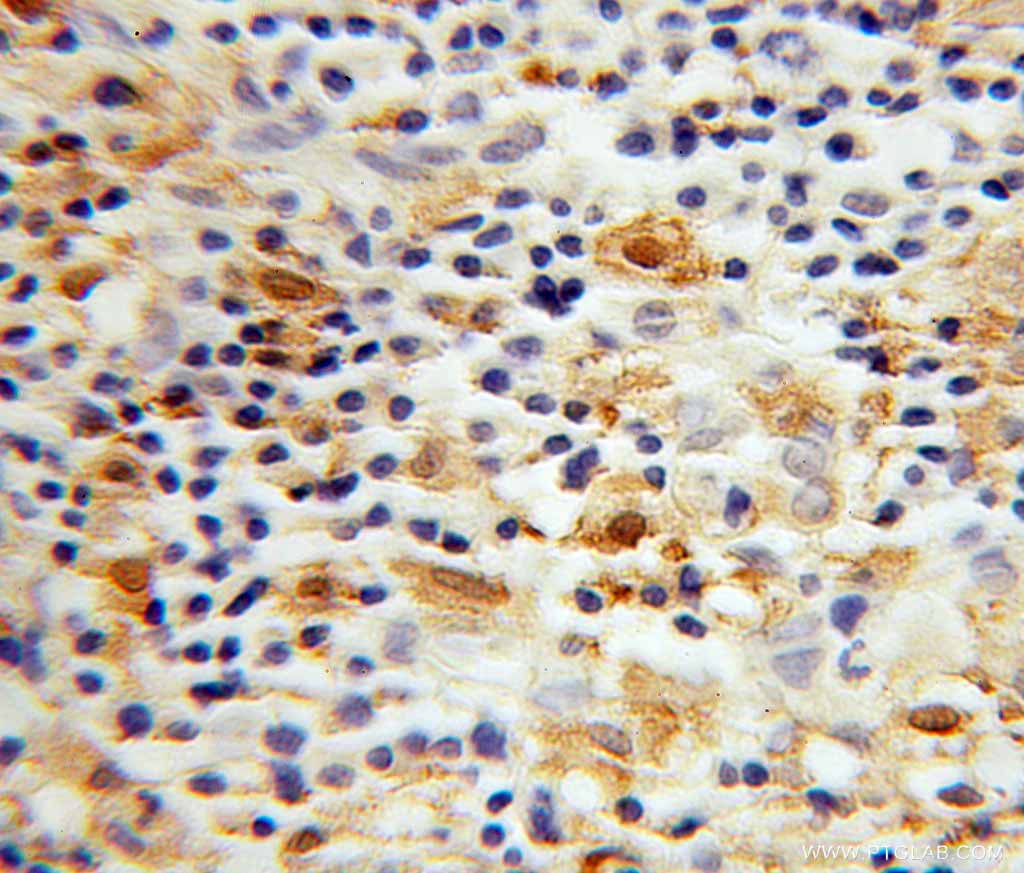 IBA1抗体を使用したパラフィン包埋ヒト悪性リンパ腫の免疫組織化学染色