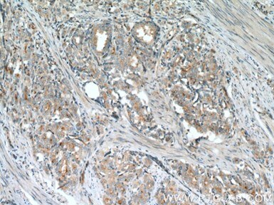 ポリクローナルVPS34（C terminal）抗体を使用したヒト前立腺がん組織の免疫組織化学染色