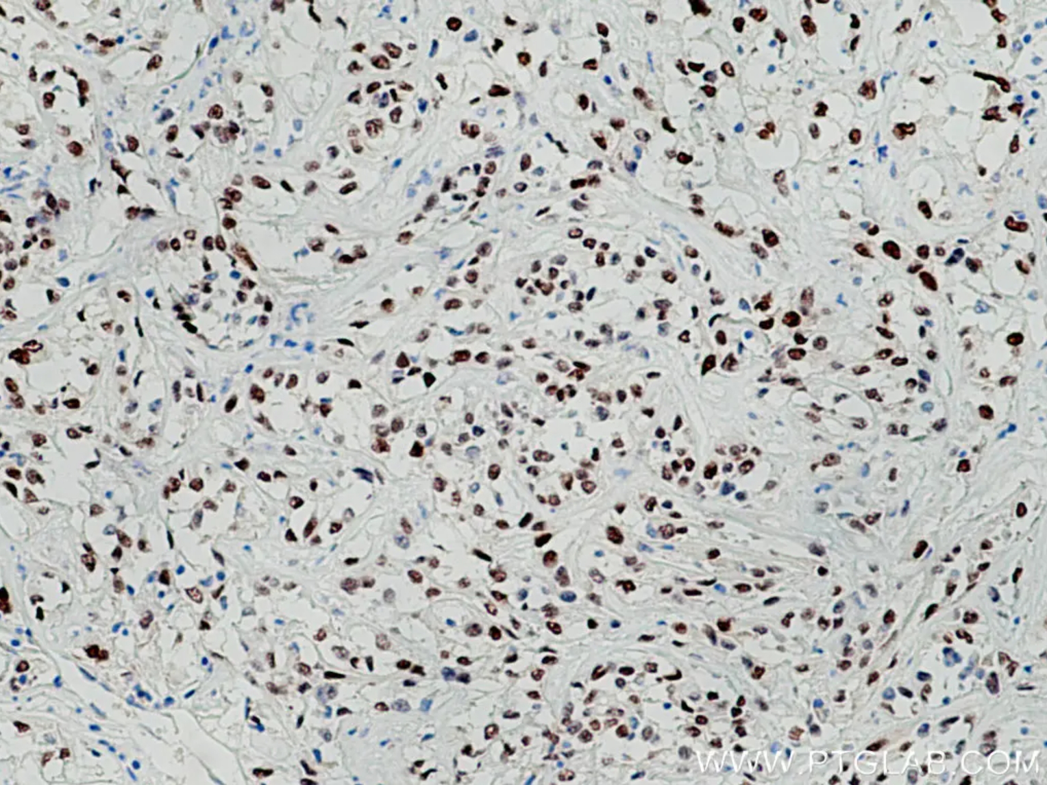 PAX8抗体を使用したパラフィン包埋ヒト腎細胞癌組織スライドの免疫組織化学染色。
