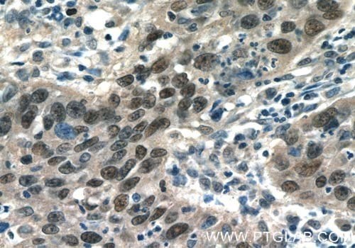 AP1,JUN,P39抗体を使用したパラフィン包埋ヒト子宮頸がん組織スライドの免疫組織化学染色