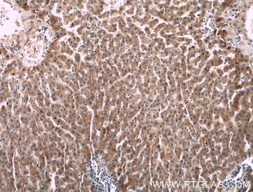 第Ⅱ因子抗体を使用したパラフィン包埋ヒト肝臓がん組織スライドの免疫組織化学染色
