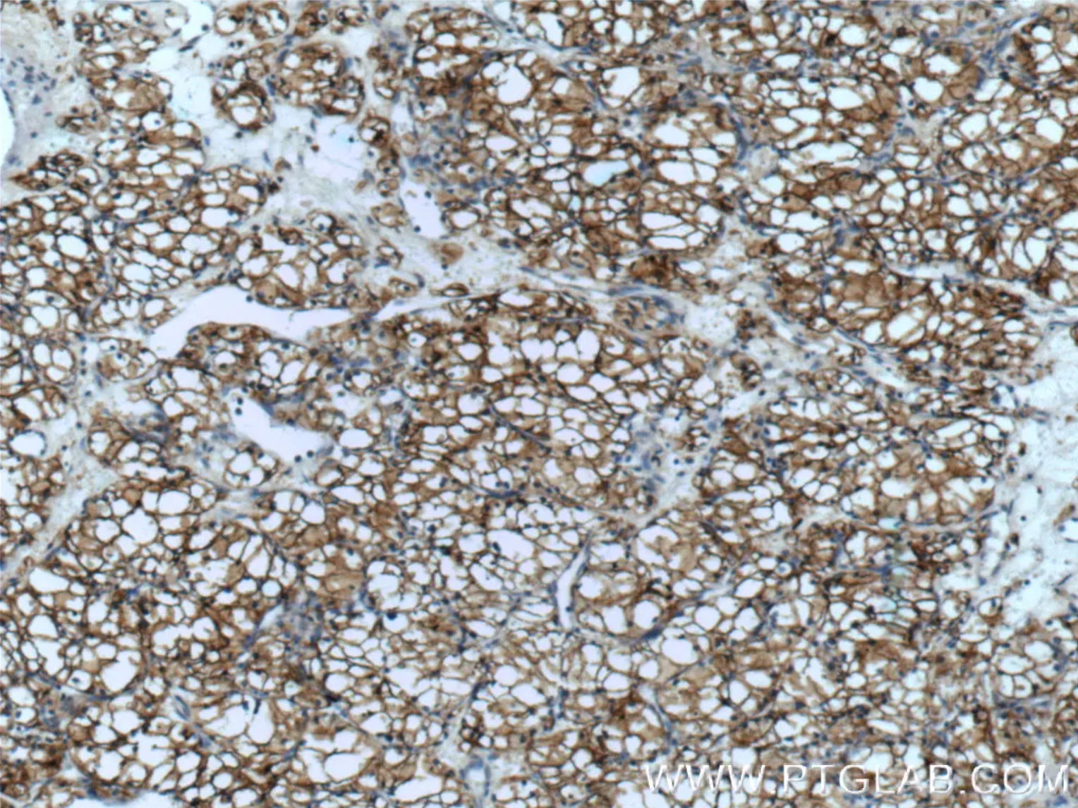 CA9抗体を使用したパラフィン包埋ヒト腎細胞癌組織スライドの免疫組織化学染色。