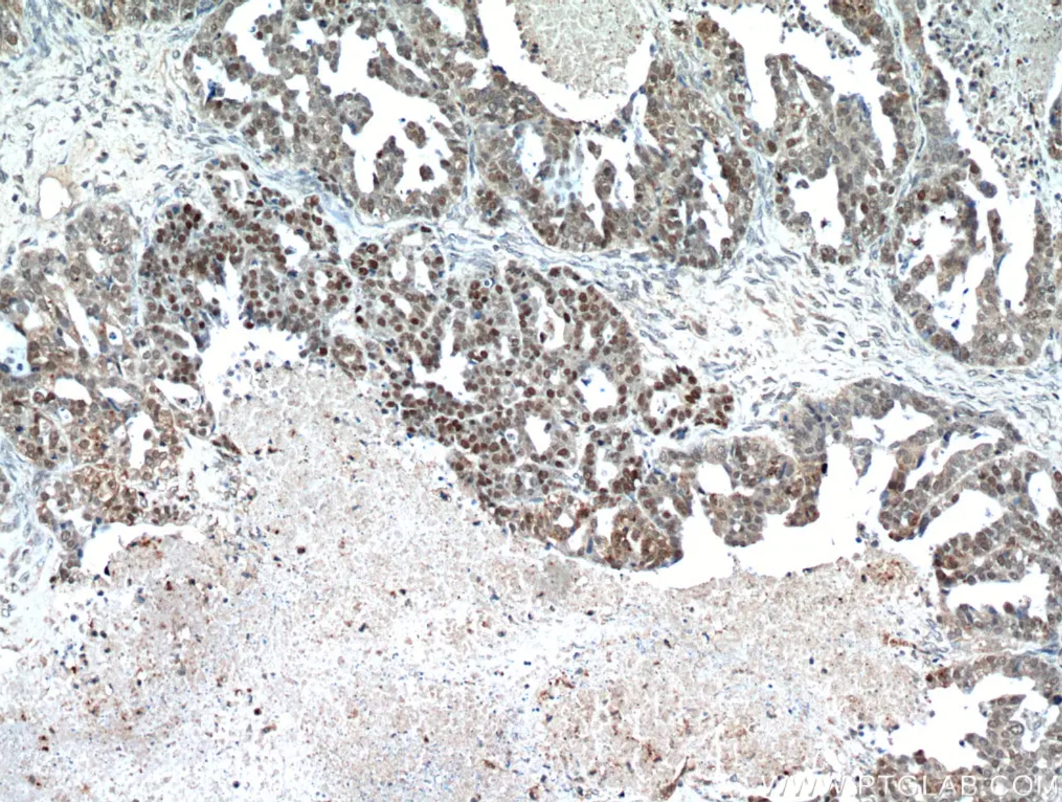 P53抗体を使用したパラフィン包埋ヒト卵巣腫瘍の免疫組織化学染色。