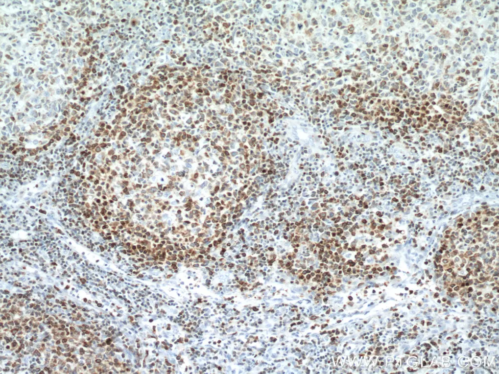 Bcl2抗体を用いたヒトリンパ腫組織の免疫組織化学染色