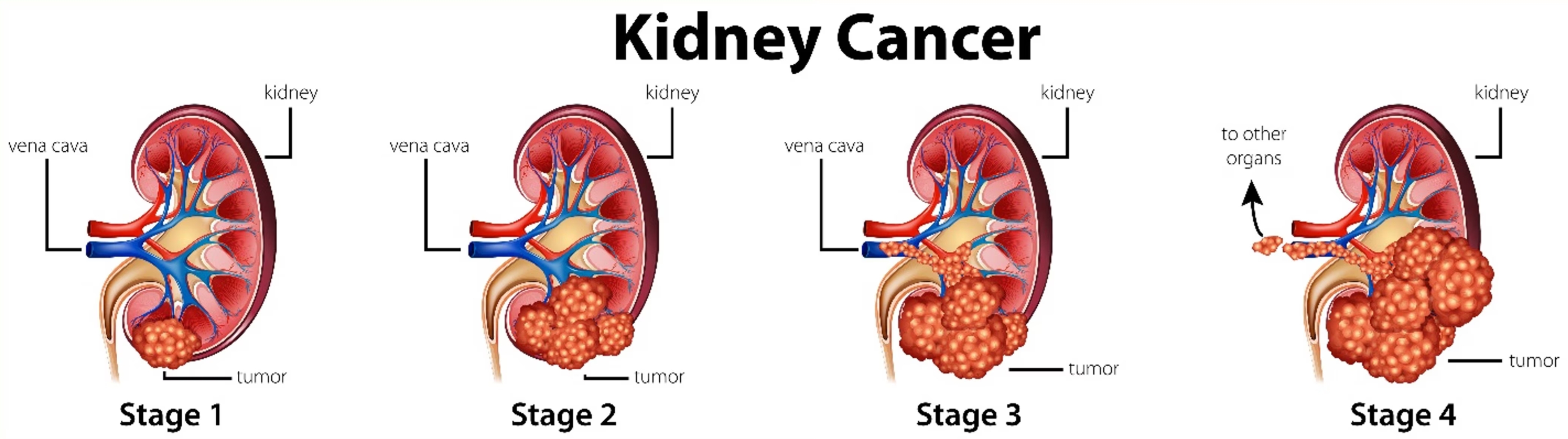 腎臓がんのステージ（Ⅰ、Ⅱ、Ⅲ、Ⅳ）