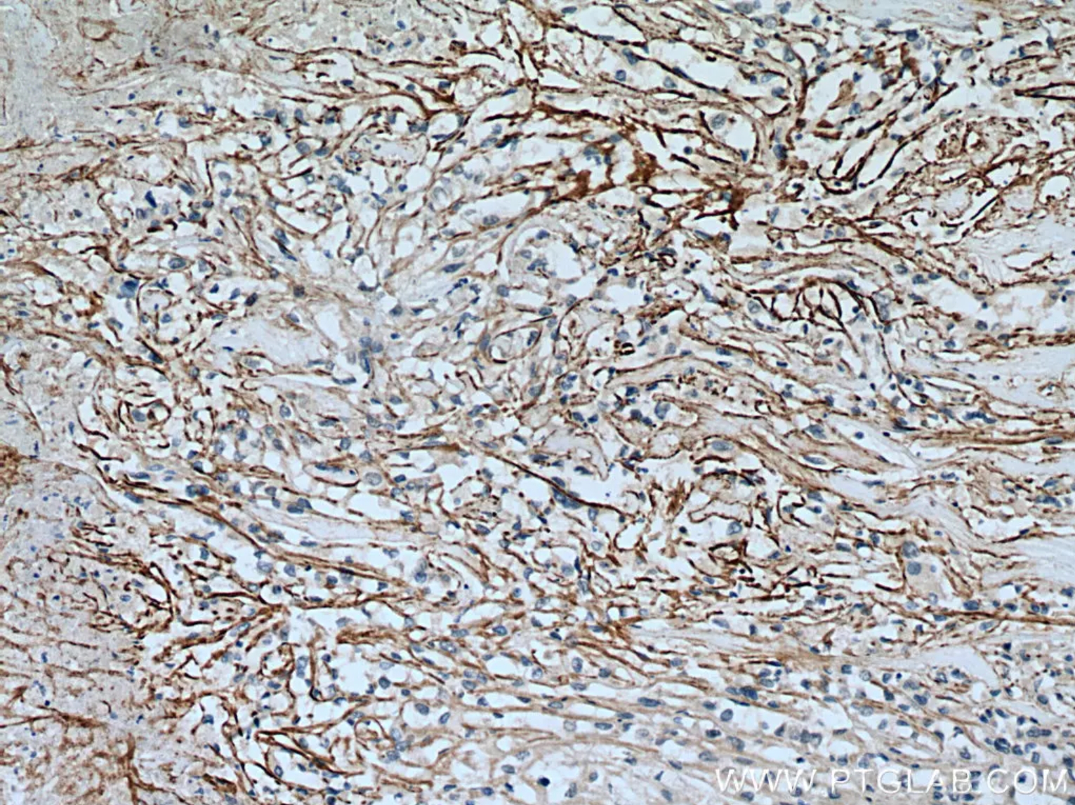 SLC7A11/xCT抗体を使用したヒト腎臓細胞癌の免疫組織化学染色