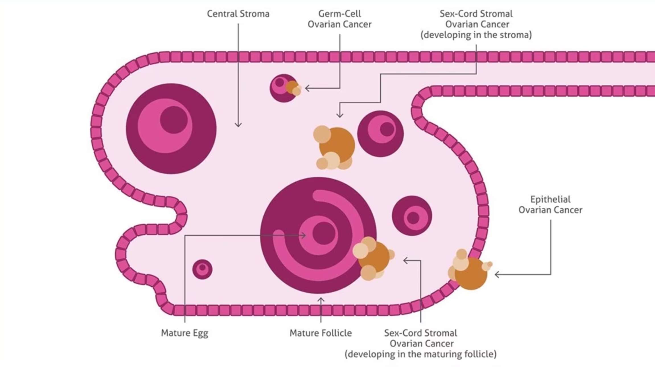 卵巣がんの種類と由来する組織部位を示した卵巣のイラスト