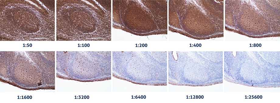 希釈倍率の異なるCD68マウスモノクローナル抗体を使用したヒト扁桃炎組織の免疫組織化学染色