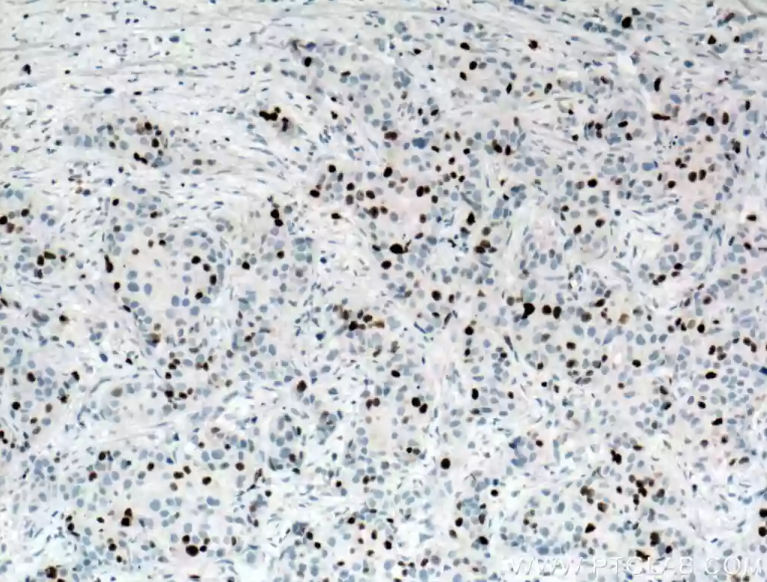 Ki67抗体を使用したパラフィン包埋ヒト乳がん組織スライドの免疫組織化学染色。