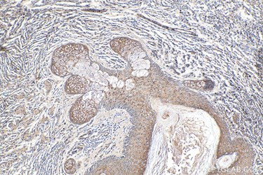 NRAS IHCeasyキットを使用したヒト悪性黒色腫組織の免疫組織化学染色