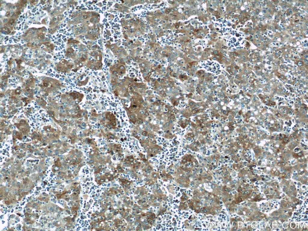 p62/SQSTM1抗体を使用したパラフィン包埋ヒト肝臓がん組織の免疫組織化学染色