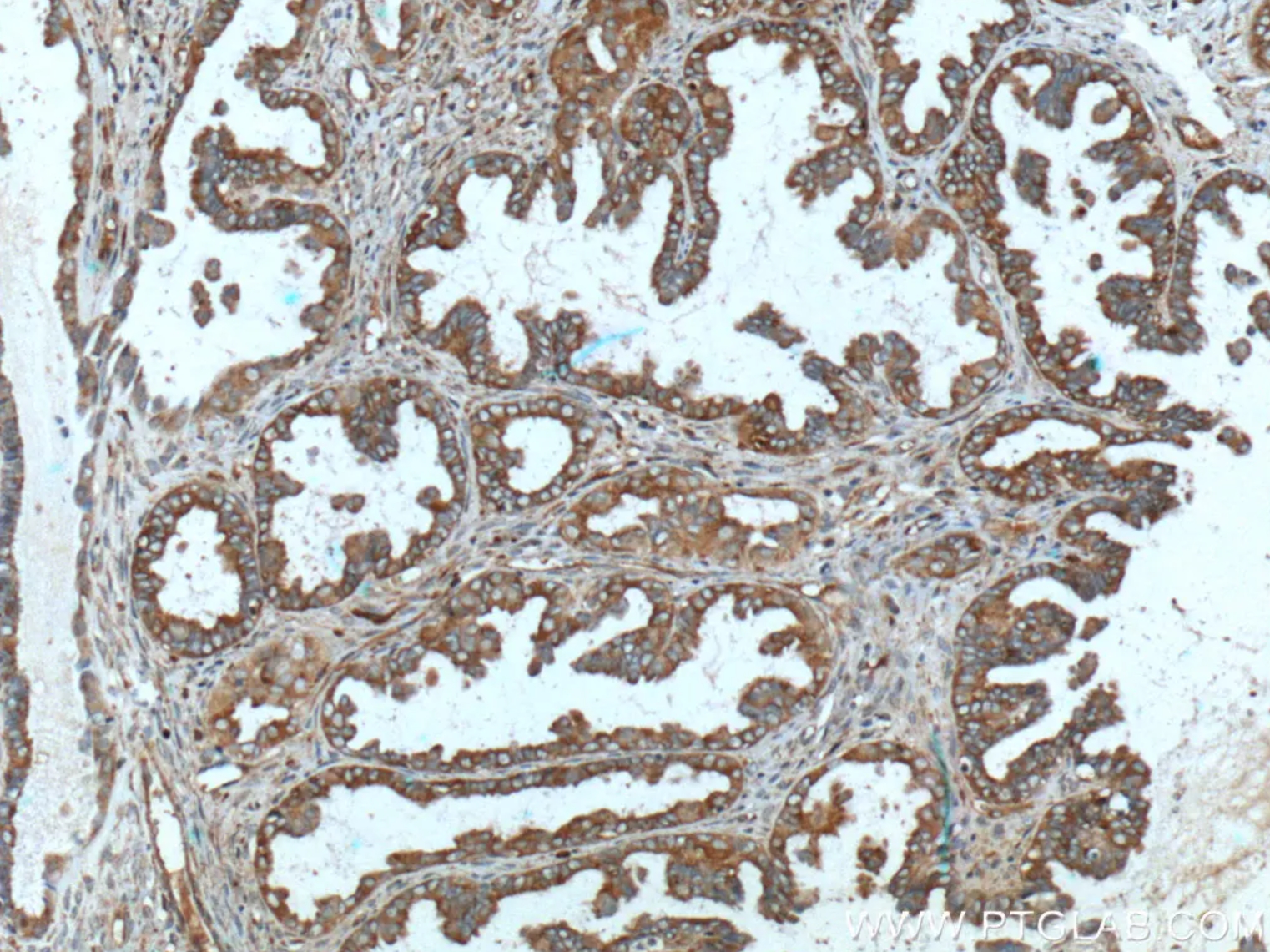 MUC16（CA125）抗体を使用したパラフィン包埋ヒト卵巣腫瘍組織スライドの免疫組織化学染色。