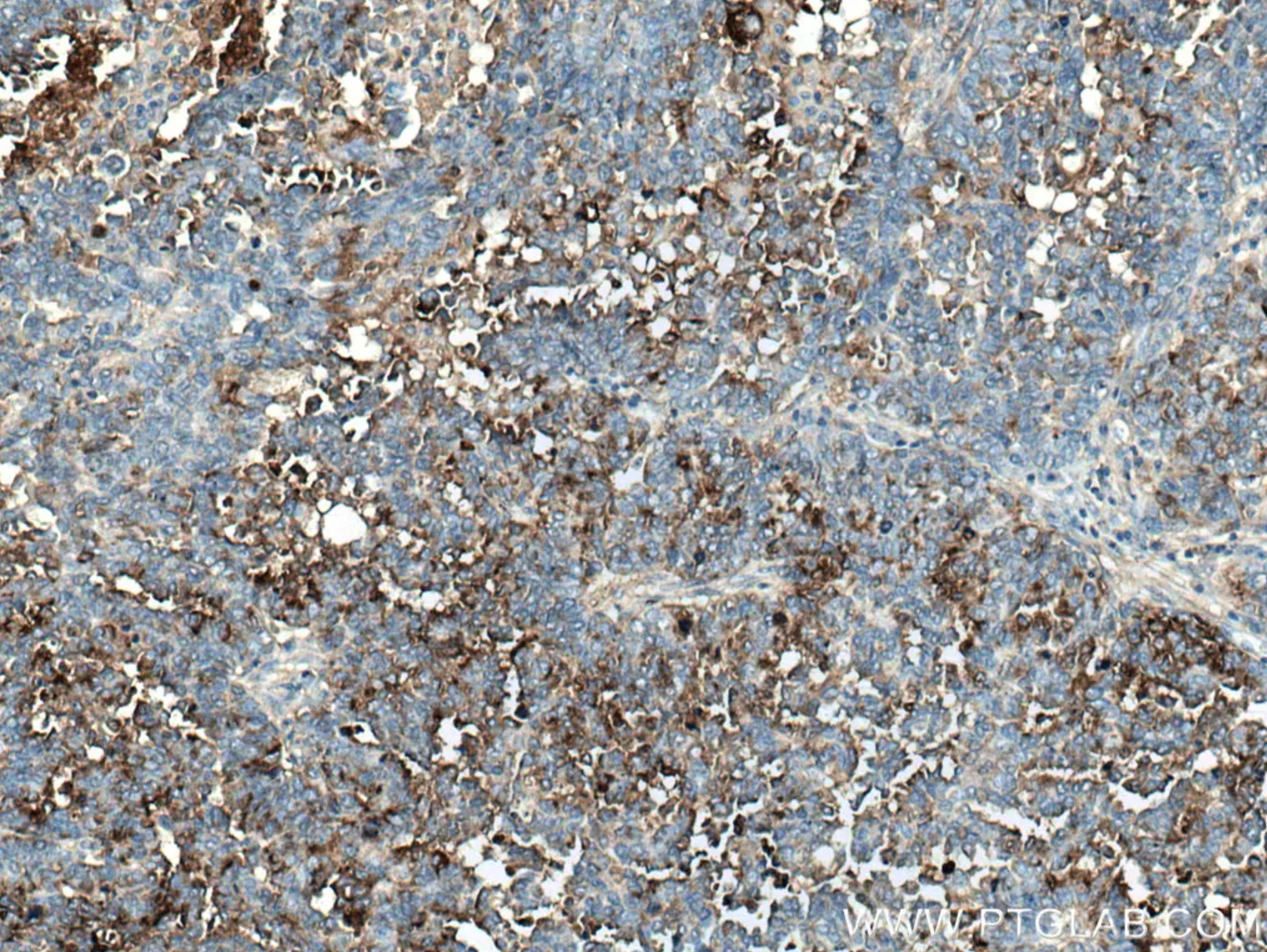 HE4抗体を使用したパラフィン包埋ヒト卵巣腫瘍組織スライドの免疫組織化学染色。